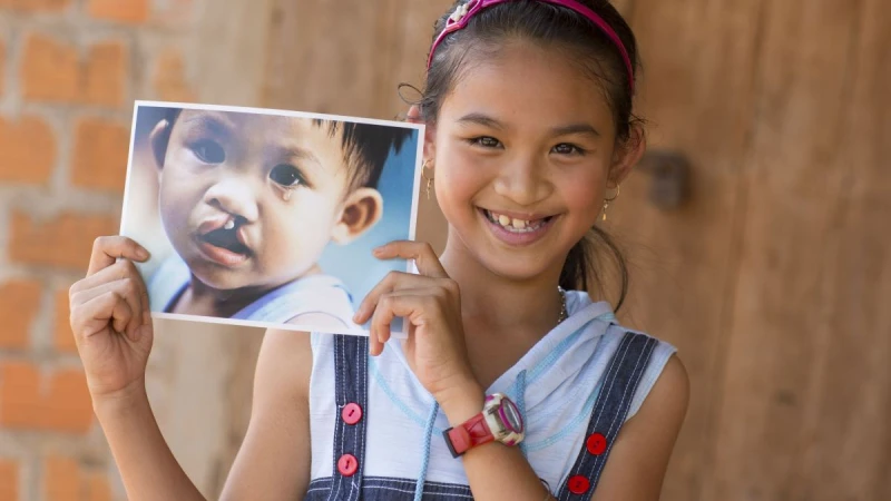 AQUA Việt Nam đồng hành cùng Operation Smile Việt Nam phẫu thuật miễn phí cho trẻ em dị tật vùng hàm mặt